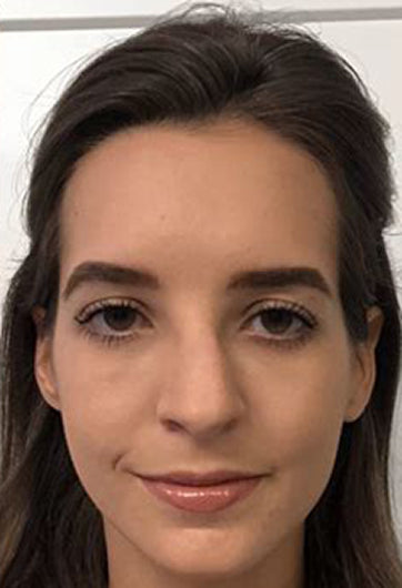 After 60 days Volufiline serum for fuller cheeks and under eye volume
