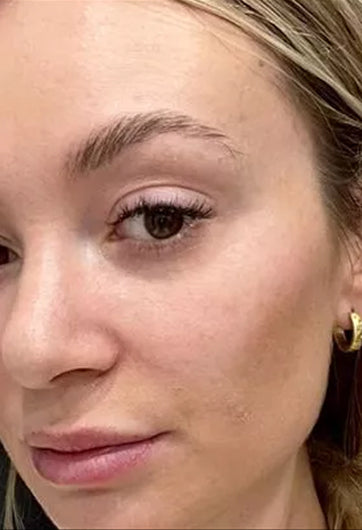 After 60 days using Volufiline serum for lip volume and anti-aging