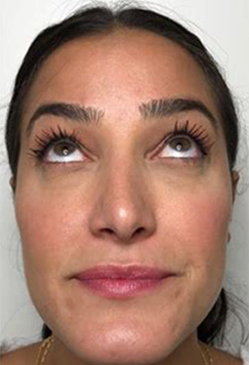 After 6 Weeks of Volufiline results for cheek lift and facial fullness