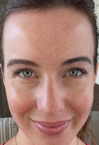 After 1 month results using Volufiline for fuller cheeks and smoother skin