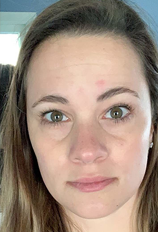 After 6 Weeks Volufiline used on cheeks and under eye area