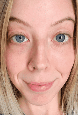 After 30 days Volufiline results for facial rejuvenation