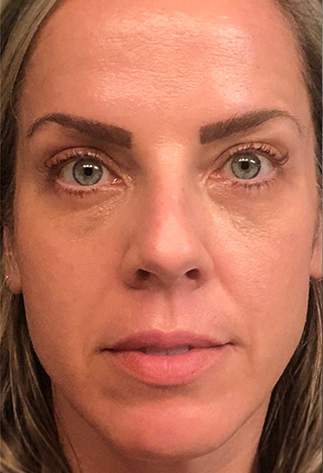 After 60 days Volufiline skin plumping under eye serum