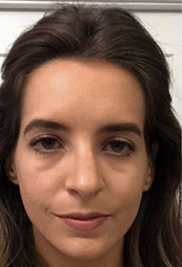 Before face volume using Volufiline