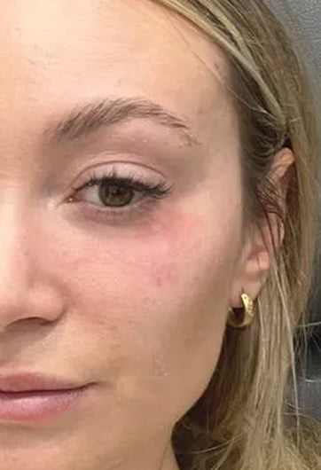 Before Volufiline for nasolabial folds and eye bags