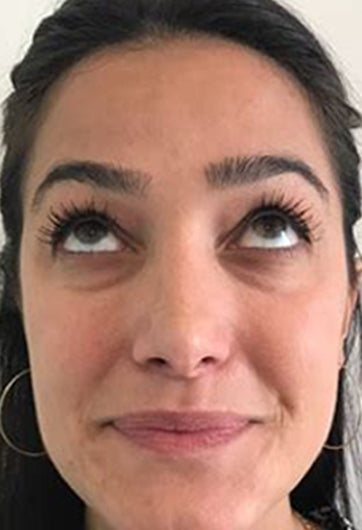 Before using Volufiline for hallow under eyes