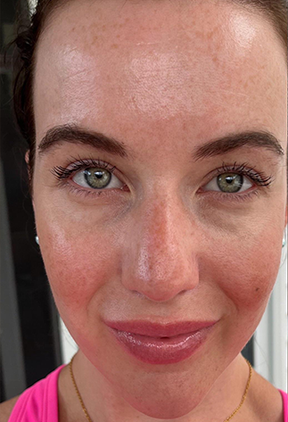 Before Volufiline facial volume serum