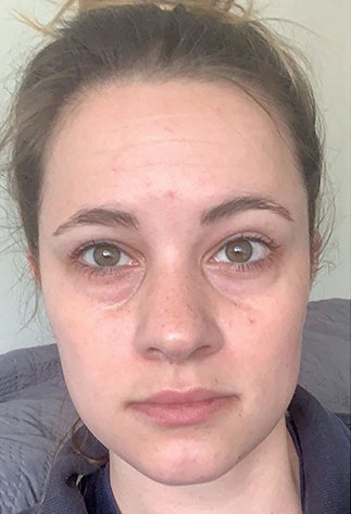 Before Volufiline for facial plumping