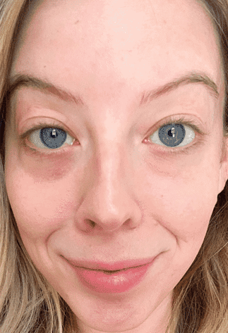 Before Volufiline hollow eyes and smile lines