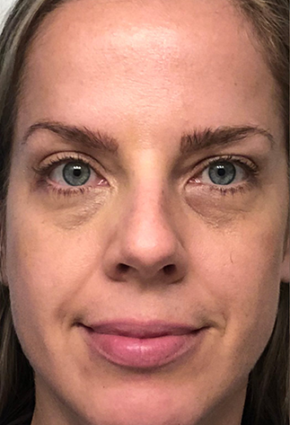 Before using Volufiline skin plumping serum